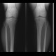 Bipartite patella: X-ray - Plain radiograph